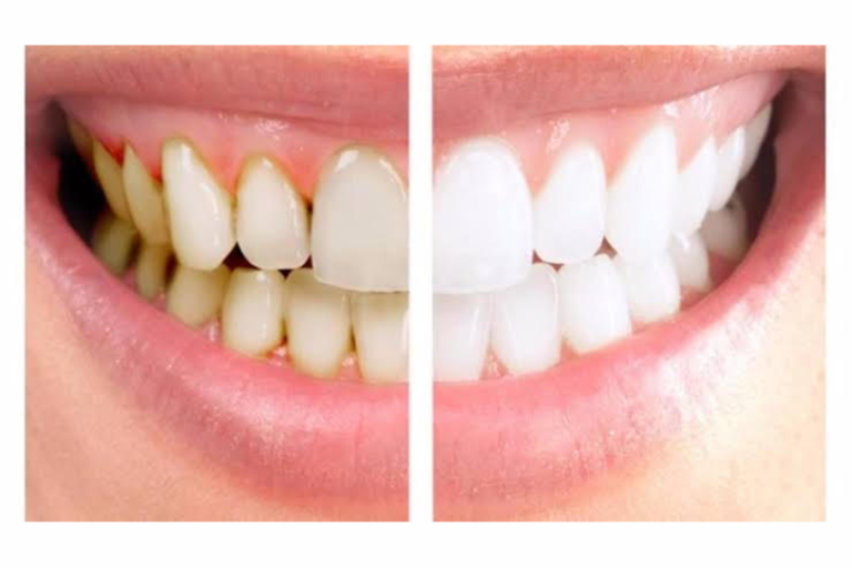 Scaling and Polishing Next Step to Prevention of Dental Problems